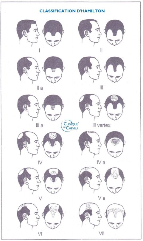 Les différentes phases de la calvitie chez l’homme | Clinique du Cheveu ...